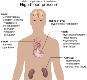 Lire la suite à propos de l’article Comment savoir si l’on fait de l’hypertension sans appareil ?